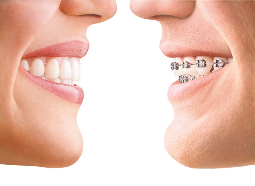 Alineadores transparentes Invisalign para corregir la posición de los dientes