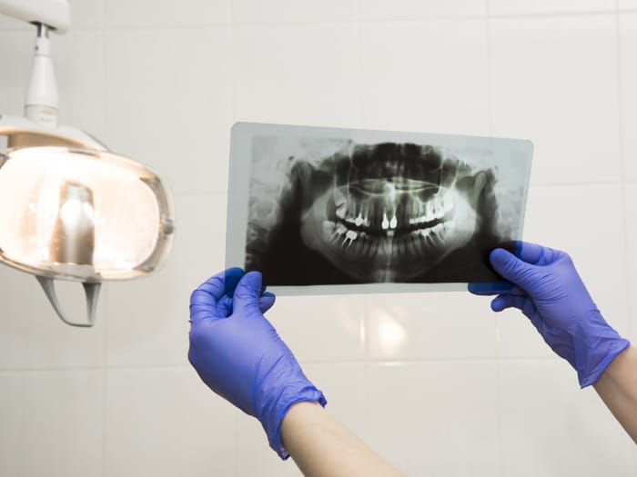 Endodoncia para conservar un diente natural en Lugo