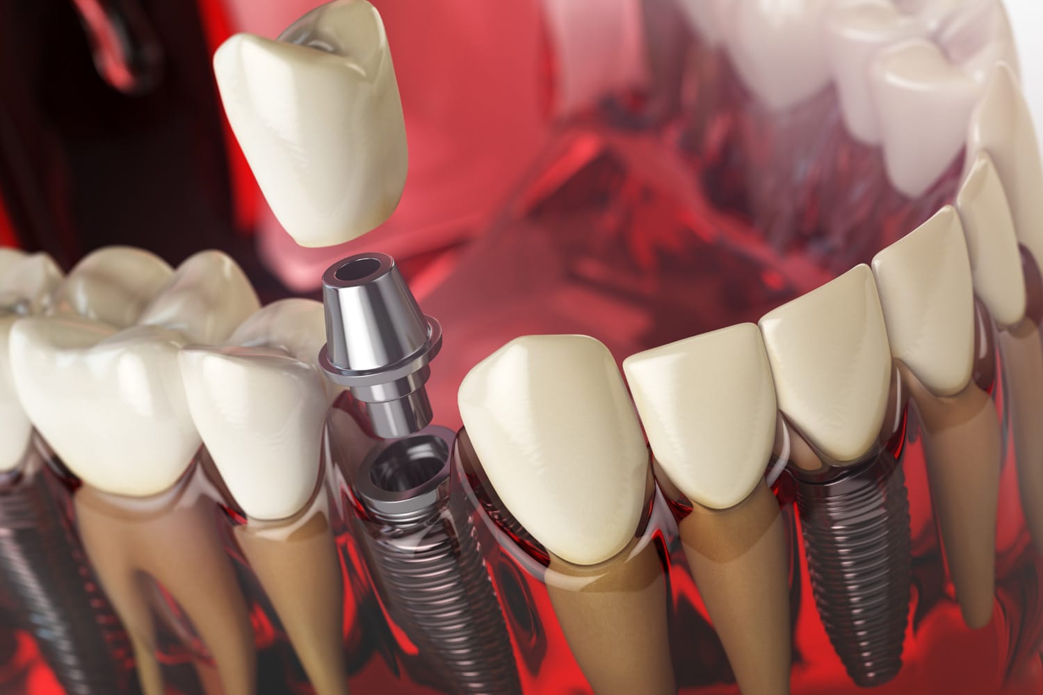Planificación digital 3D para tratamientos de implantes dentales