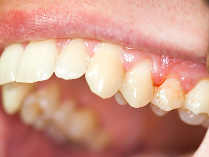 Periodoncia y tratamiento de encías en Lugo