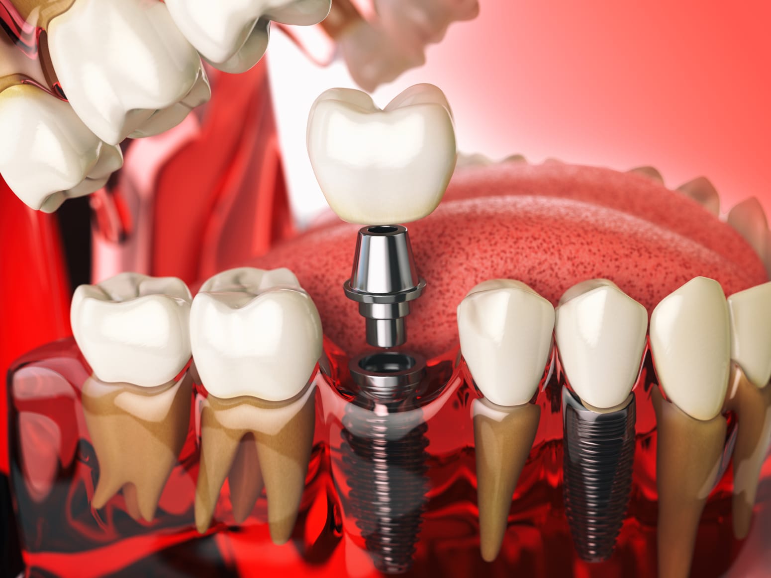 Implante dental para sustituir un diente perdido en Lugo