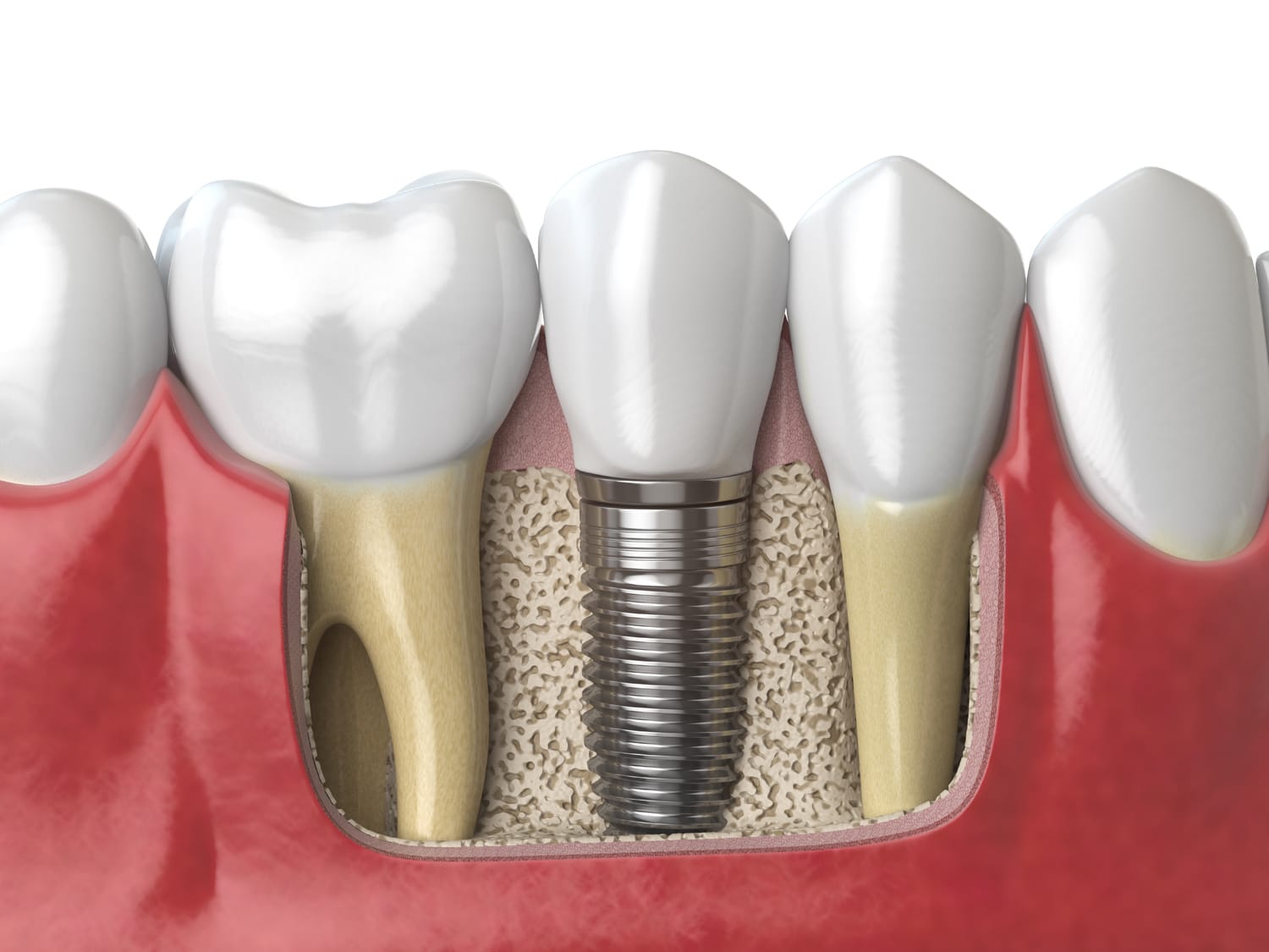 Tratamiento con implantes dentales para recuperar función y estética de la sonrisa
