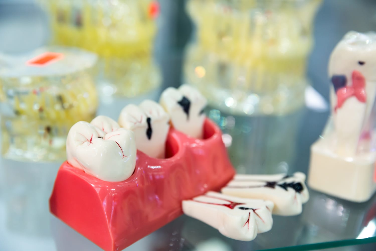 Tratamiento de endodoncia para limpiar el interior de un diente afectado