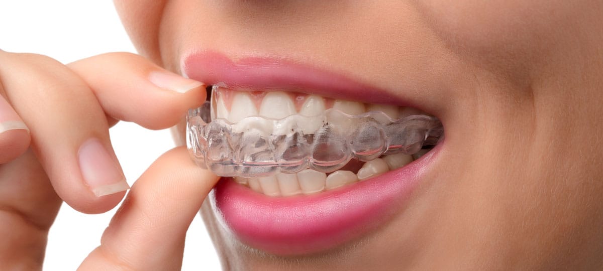 Alineadores transparentes de ortodoncia invisible Invisalign en Lugo