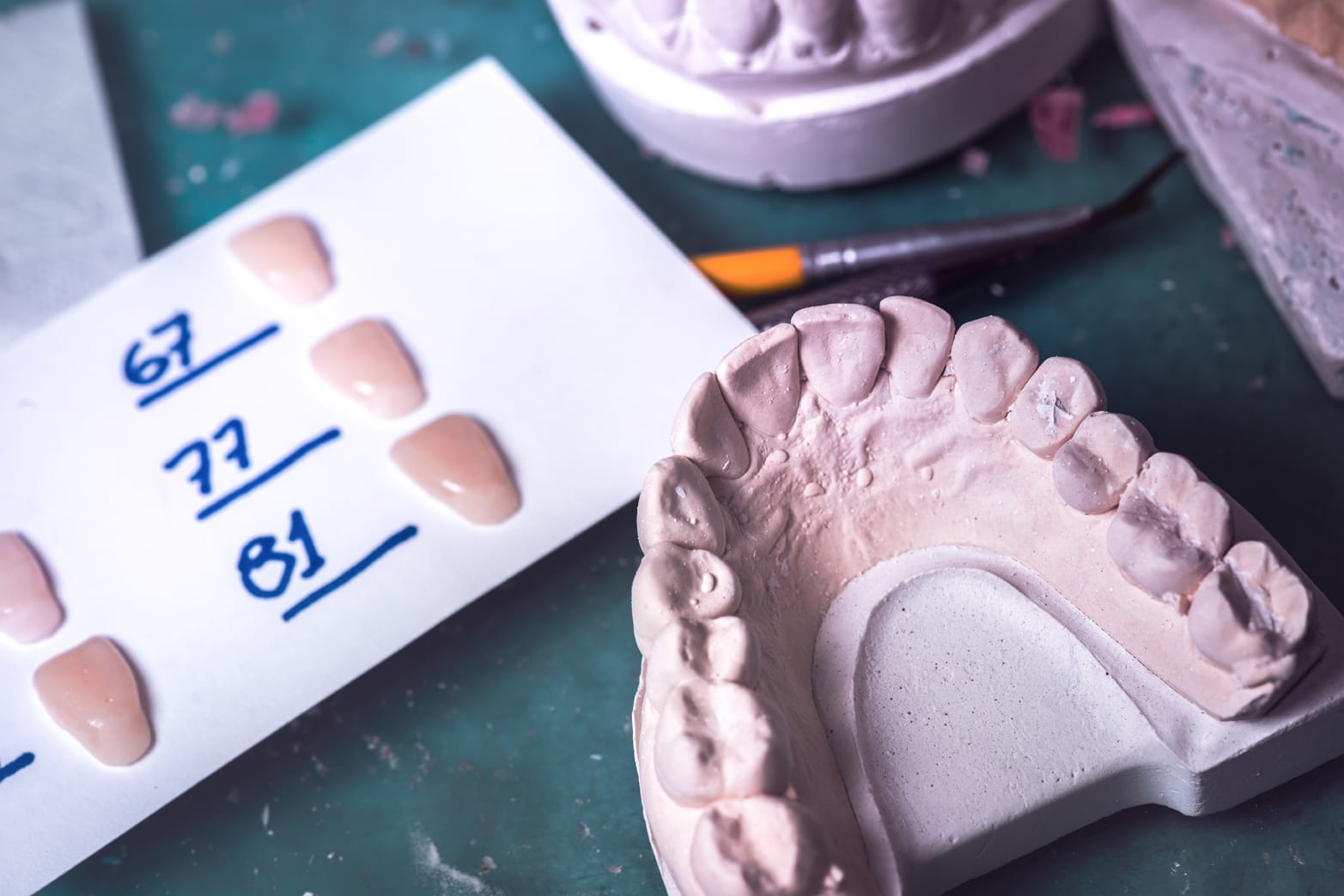 Carilla dental estética para mejorar forma, color y armonía de los dientes