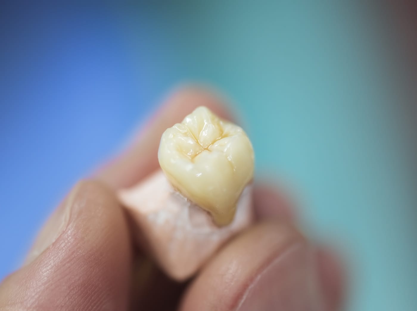 Traumatismo dental con pérdida o fractura de un diente y necesidad de atención odontológica