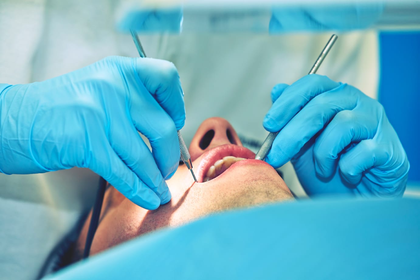 Curetaje dental para tratar encías y superficies radiculares afectadas por enfermedad periodontal