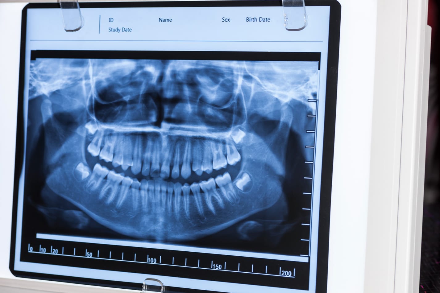 Cirugía mandibular para corregir alteraciones funcionales y de la mordida