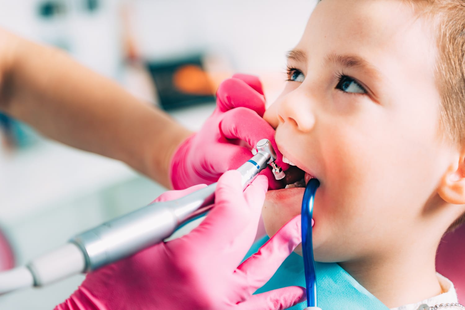 Empaste dental de composite para restaurar un diente afectado por caries