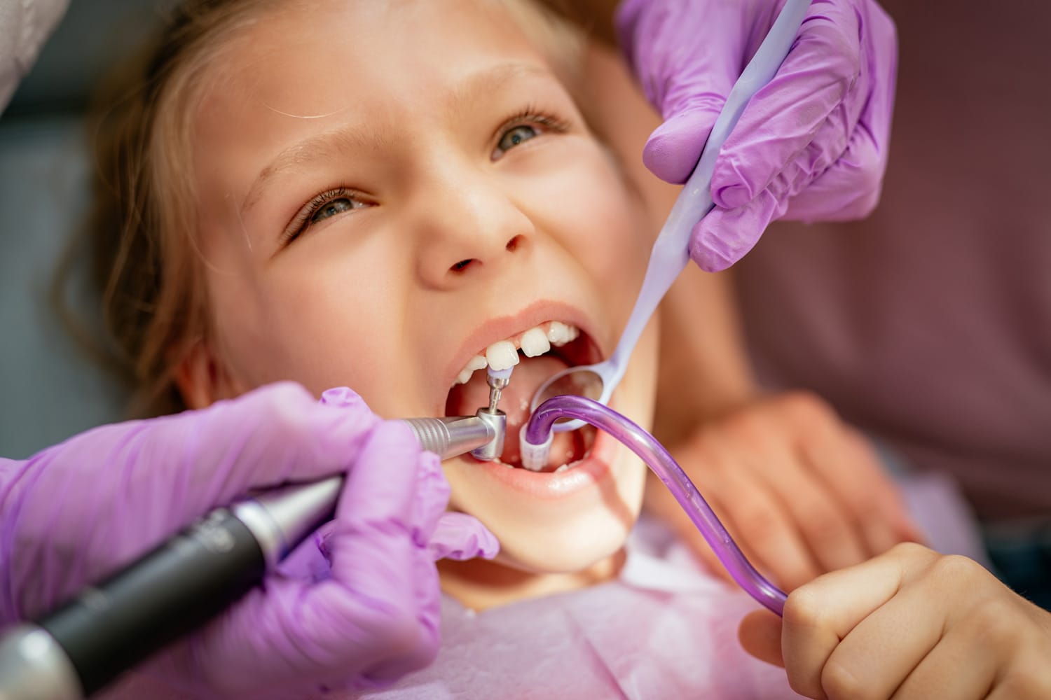 Pulpotomía infantil para tratar la pulpa de un diente de leche afectado por caries