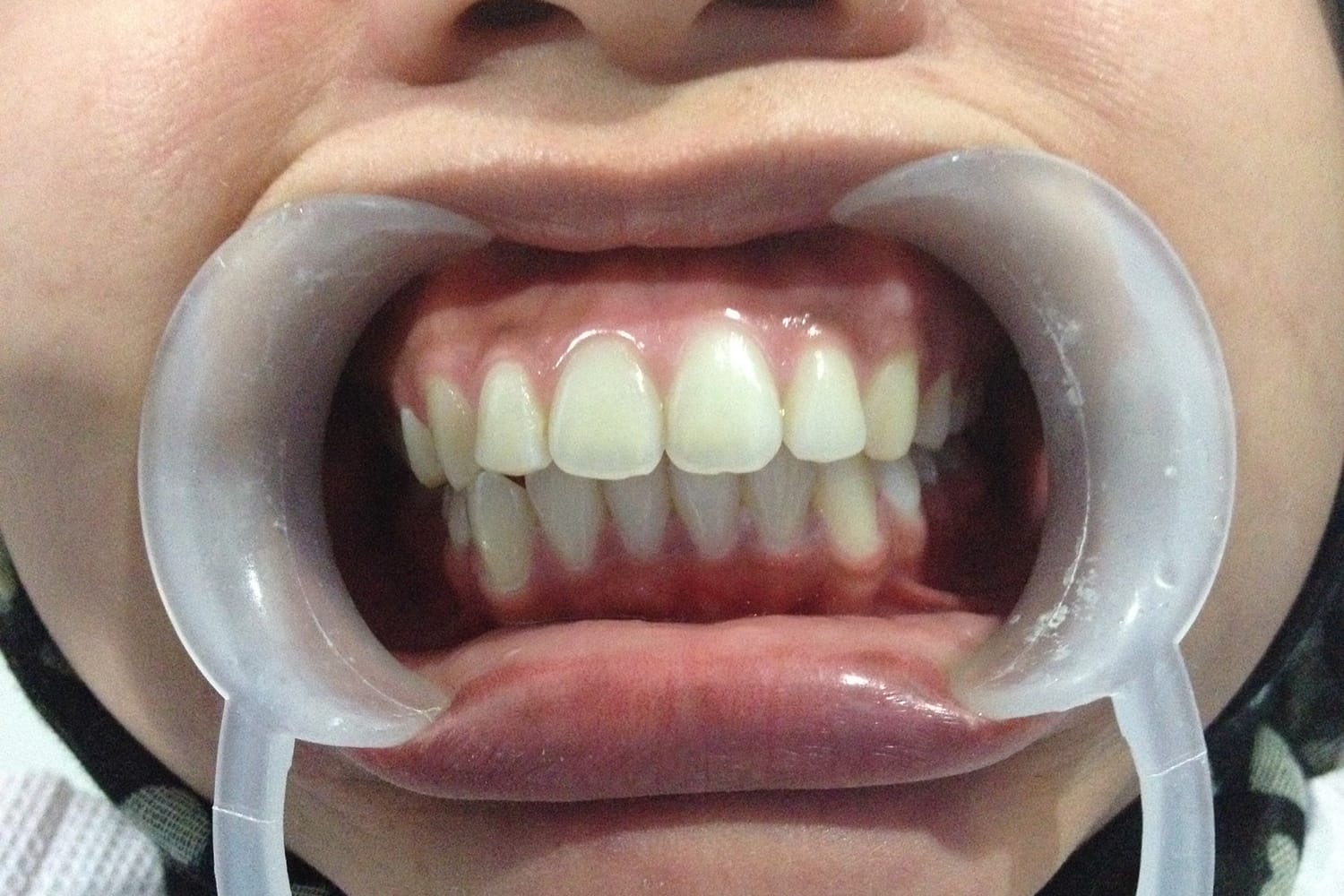Maloclusión dental o alteración de la relación entre los dientes y la mordida