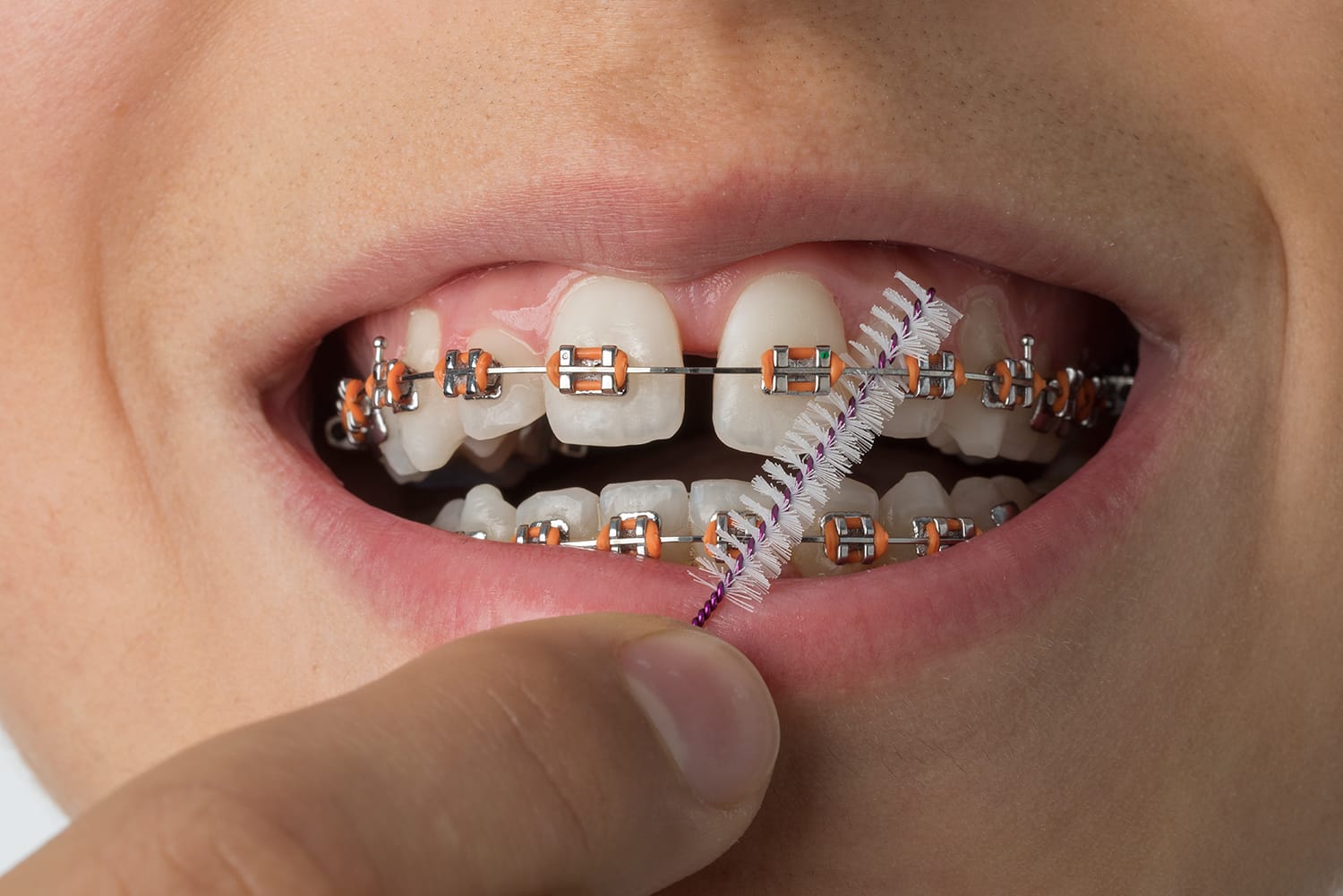 Brackets dentales para tratamiento de ortodoncia en Lugo