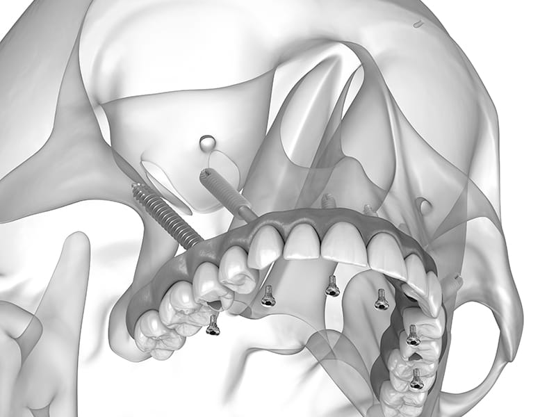 Representación de implantes cigomáticos en el maxilar superior