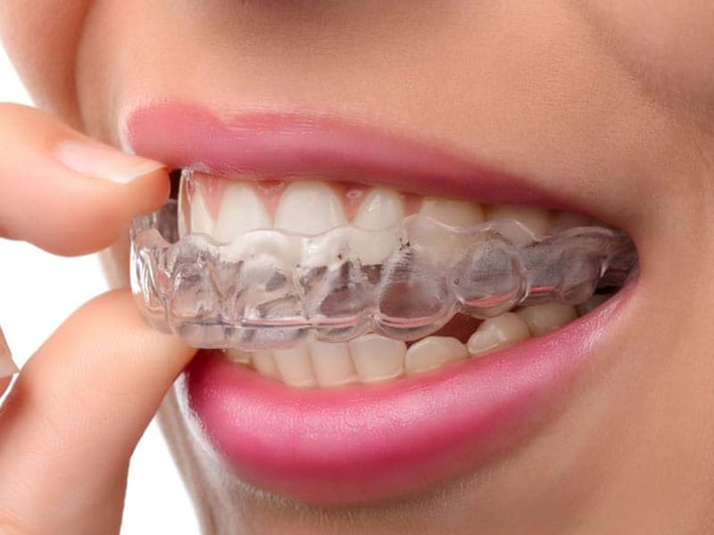 Alineadores transparentes Invisalign para ortodoncia invisible en Lugo
