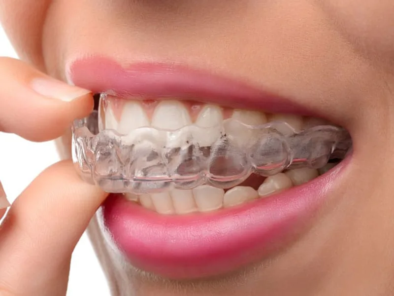 Invisalign l ortodoncia invisible invisalign lugo