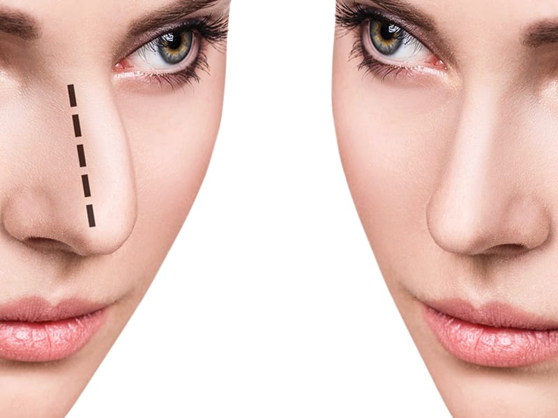 Rostro femenino de perfil antes y después de una rinoplastia estética