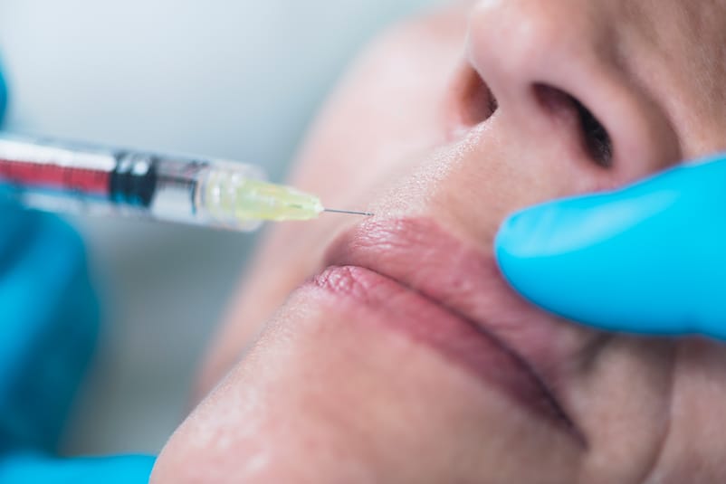 Tratamiento con bótox para líneas de expresión y arrugas alrededor de la boca