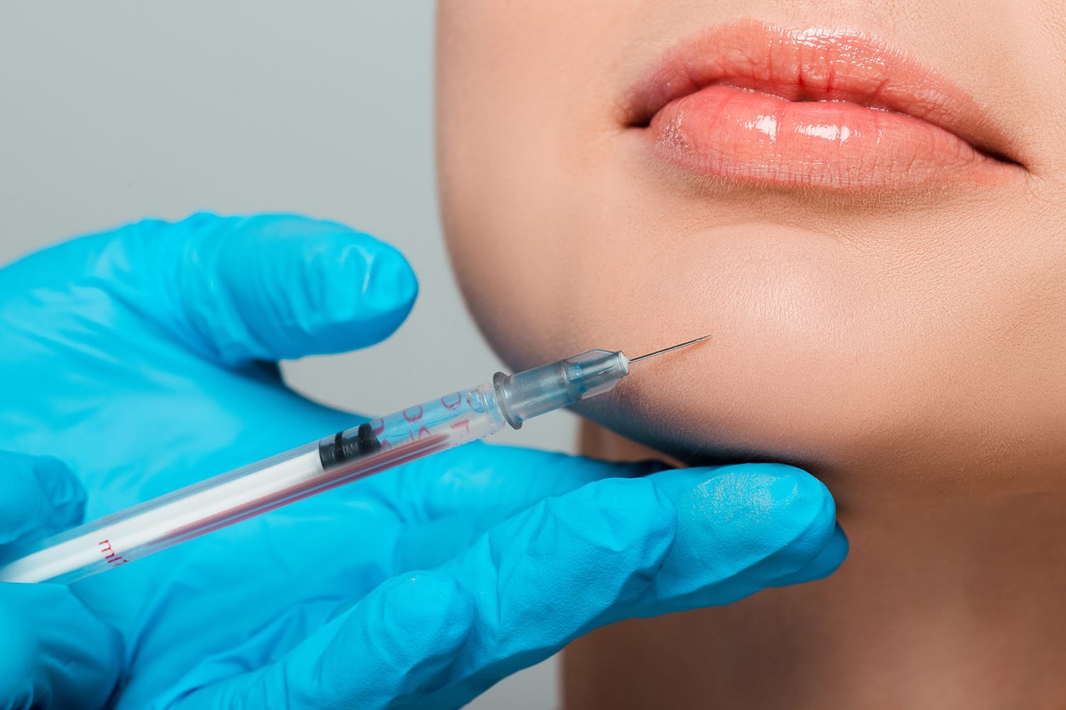 Mentoplastia con prótesis para mejorar la proyección del mentón