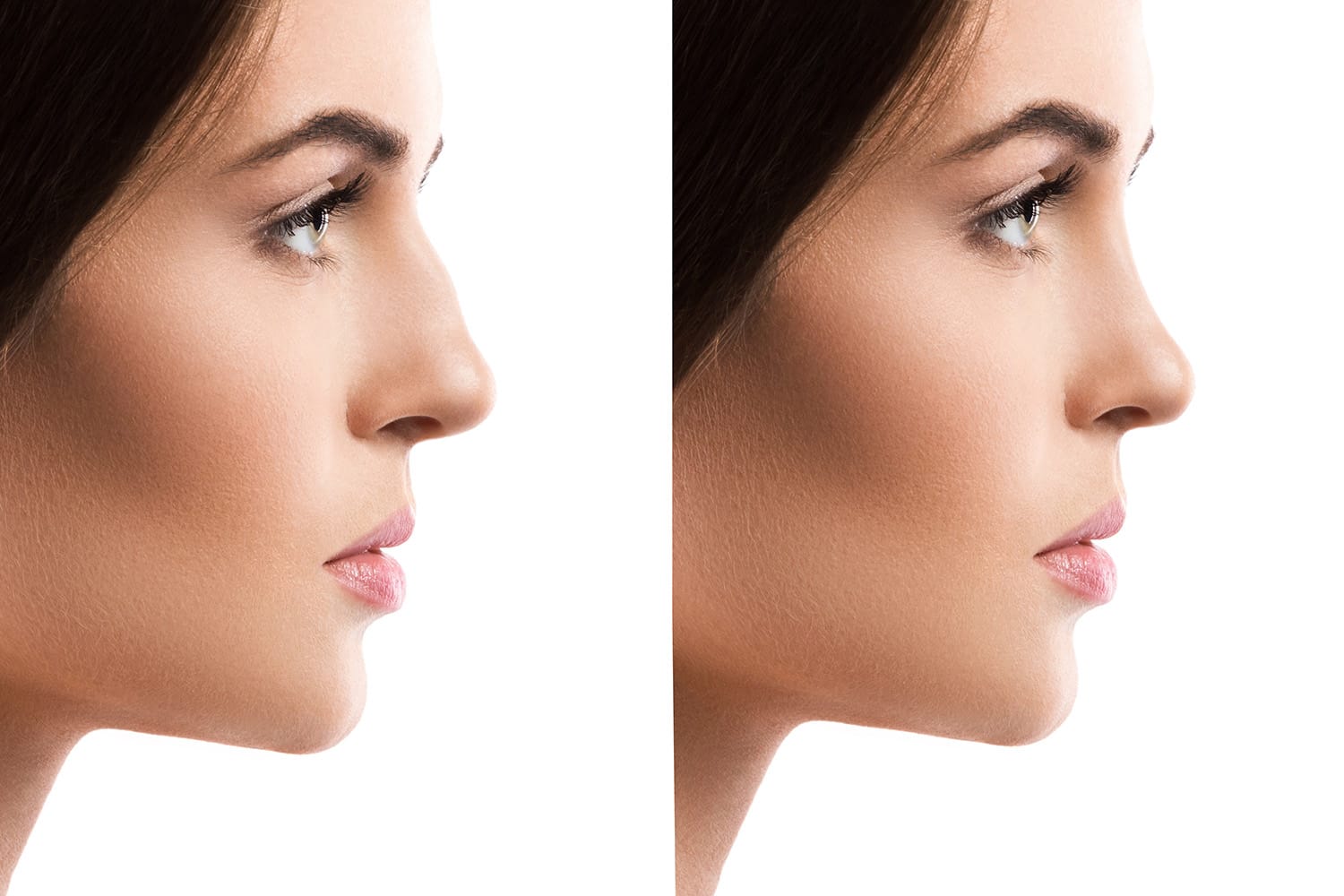 Resultado de una rinoplastia orientada a función y estética nasal