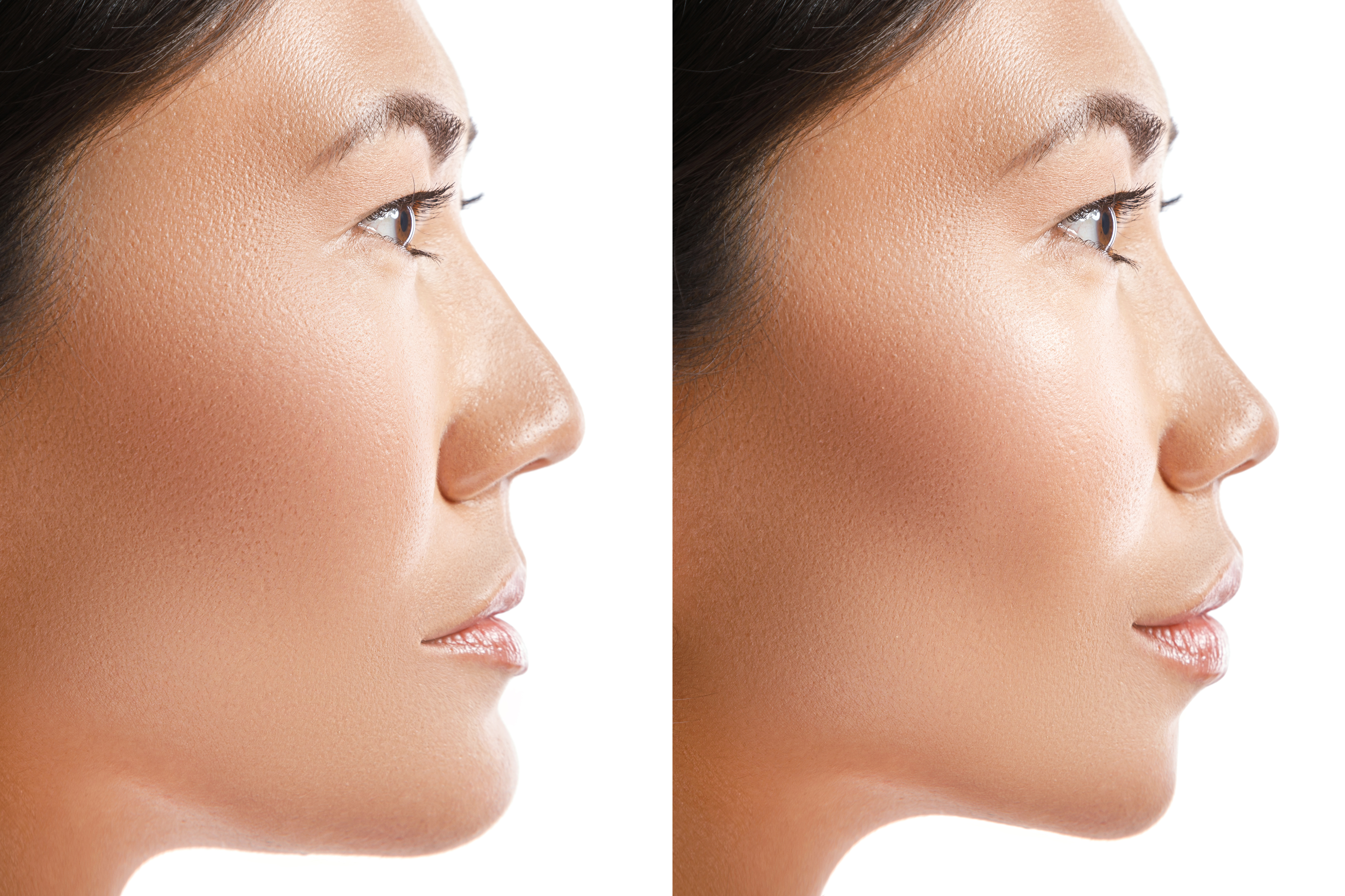 Resultado de cirugía estética facial Comparativa del rostro antes y después de un procedimiento de cirugía estética