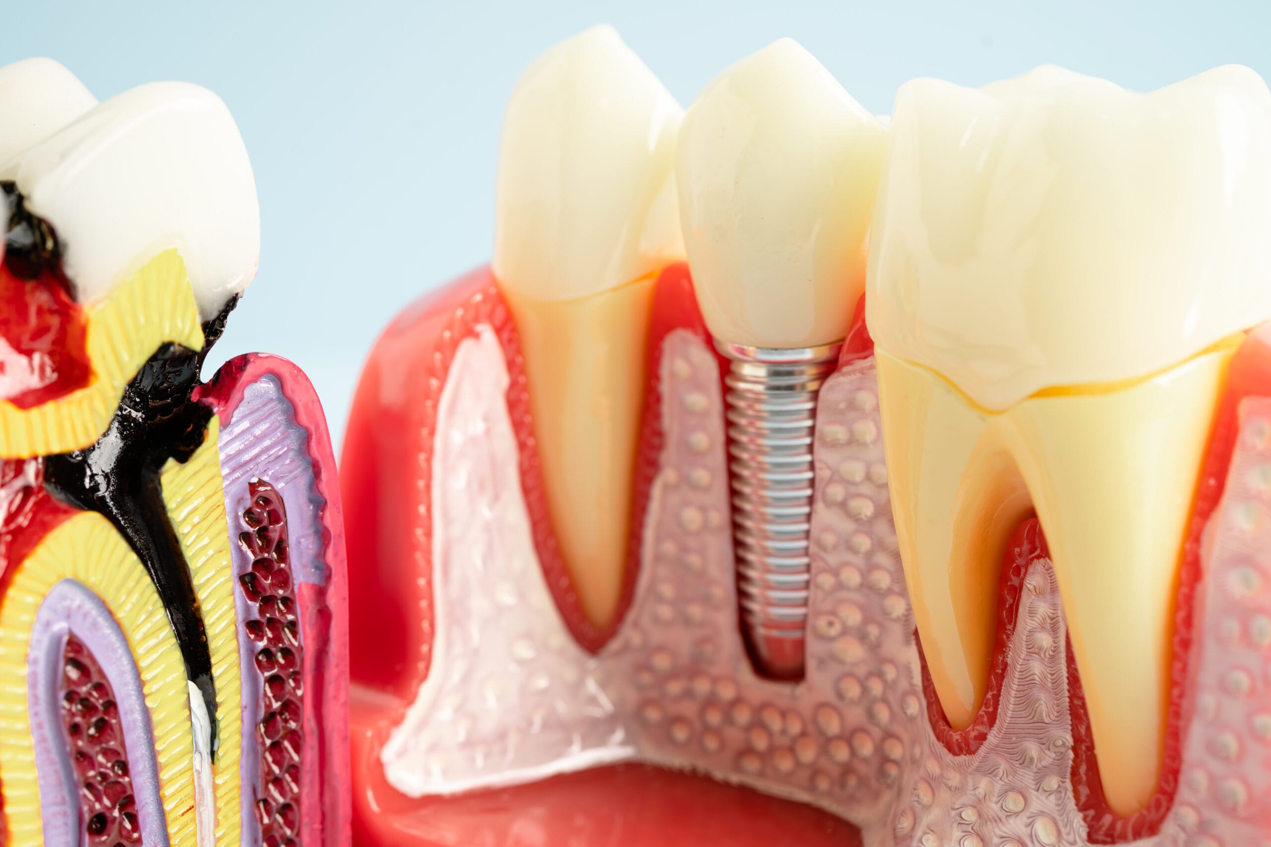 Representación anatómica de un implante dental colocado en el hueso