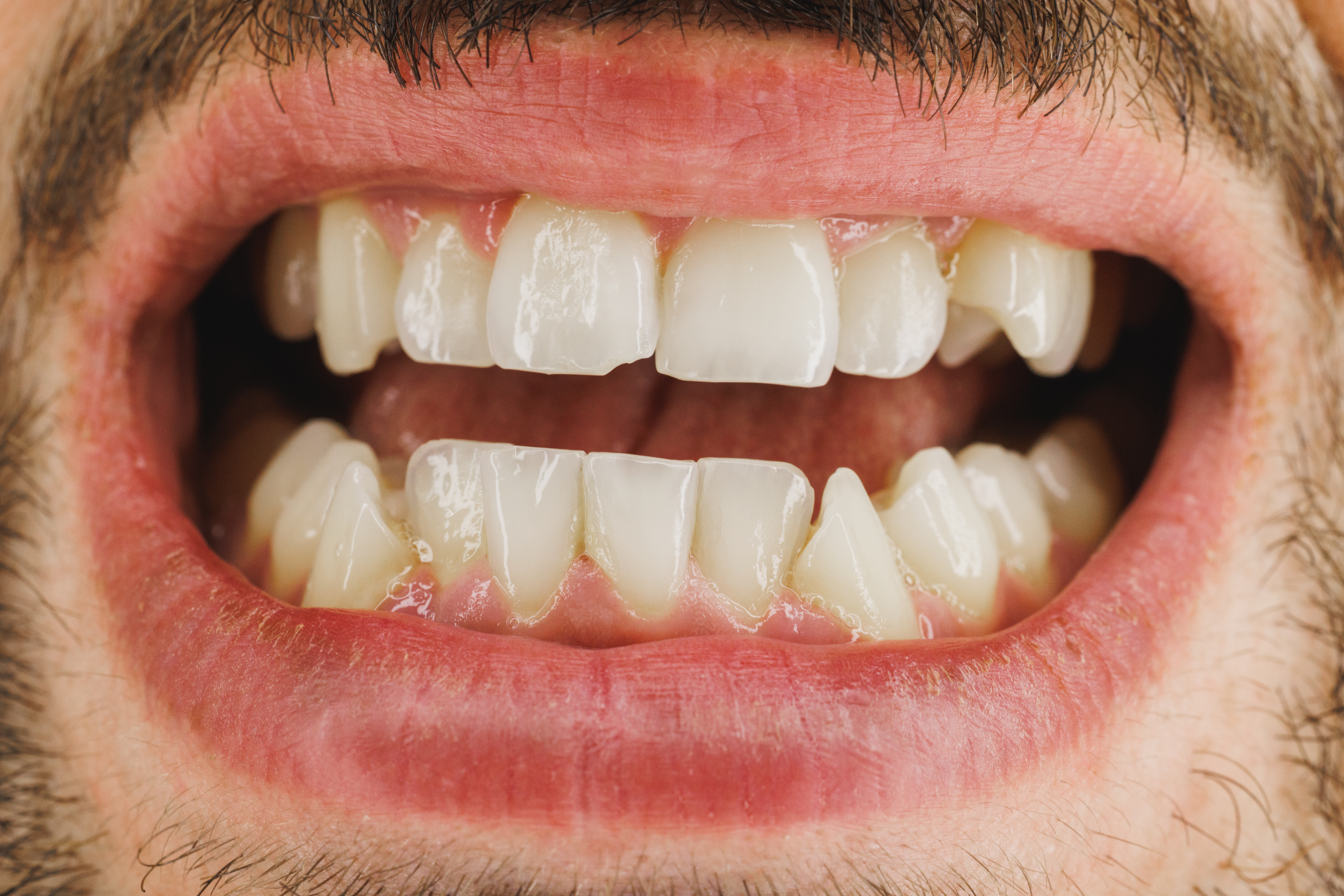 Primer plano de los dientes de un hombre antes de un tratamiento de ortodoncia