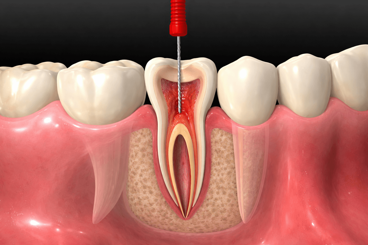 Endodoncia para tratar el interior de un diente dañado