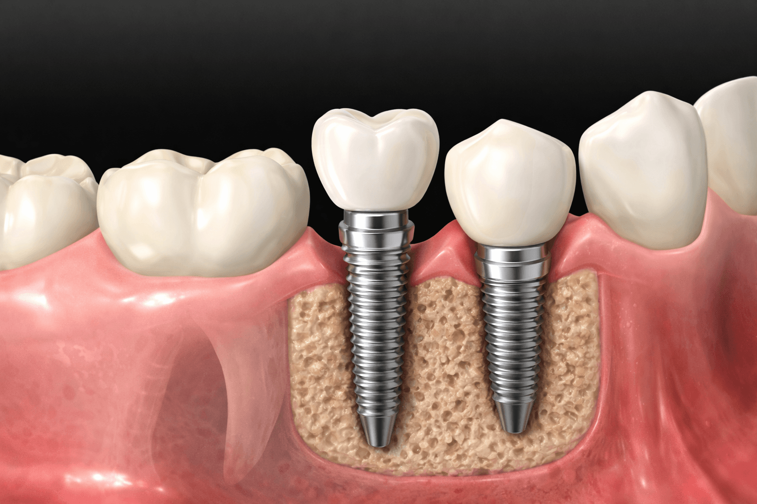 Implante dental utilizado para sustituir un diente perdido